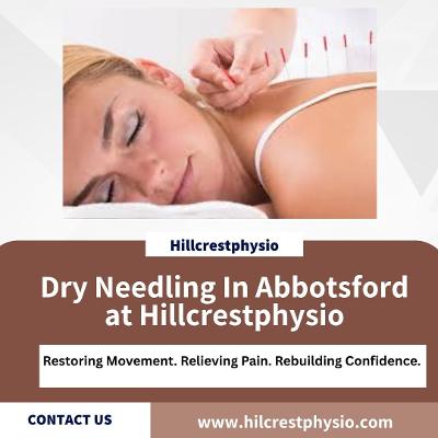 Dry Needling In Abbotsford - Hillcrestphysio